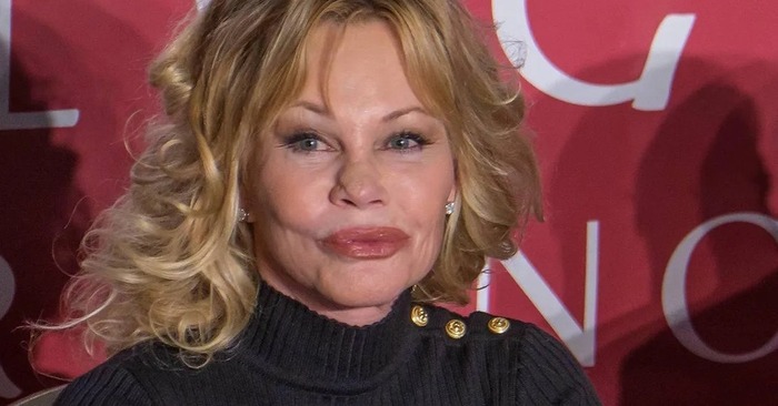  She can’t close her mouth because of the fillers. 64-year-old Griffith went too far with fillers