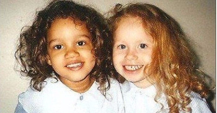  „Es war eine große Überraschung, solche Zwillinge zu sehen“: Die Mädchen wurden mit unterschiedlichen Hautfarben geboren