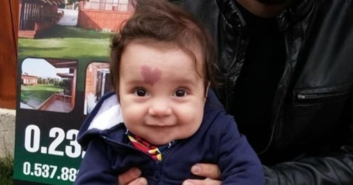  „So sieht der Junge jetzt aus“: Das Baby wurde mit einem Herz-Muttermal auf der Stirn geboren